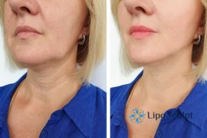 Double chin before and after Hi-Fu treatment 4 Book your double chin treatment Dorset today! We are here to help!