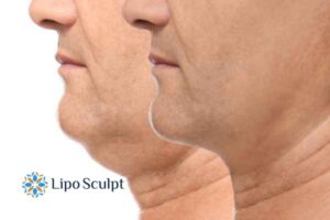 Double chin before and after Hi-Fu treatment 2 Double chin treatment Dorset from Lipo Sculpt - feel more confident today!