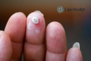 Cryopen Top 5 Treatable Conditions 4 Do you have a persistent wart of verruca that you cannot shit? Cryopen Dorset treatment will work call us NOW!