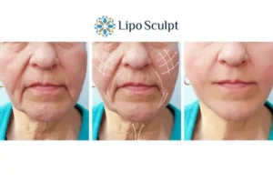 Explaining Morpheus8 And What It Can Do For You 3 Boost your confidence with Morpheus8 Dorset call our team today!