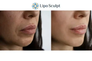 Explaining Morpheus8 And What It Can Do For You 4 Morpheus8 Dorset the best results - call our team today!