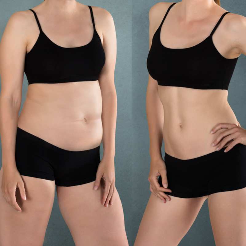 Does Fat Freezing at Home Work? DIY Devices vs Professional Cryolipolysis 2 before and after Cryolipolysis Dorset