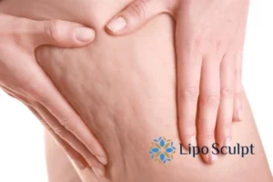 CoolSculpting for Legs: The Innovative Approach to Redefining Your Legs 5 Start your journey today book your coolsculpting treatment Dorset online today!