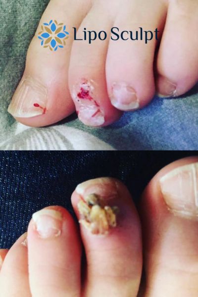 Wart removal customer results from Lipo Sculpt Dorset
